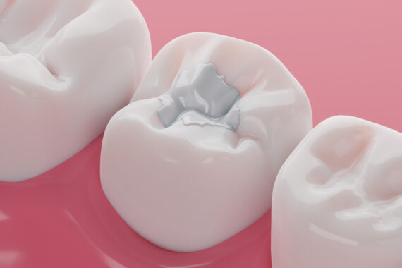 composite-filling-procedure