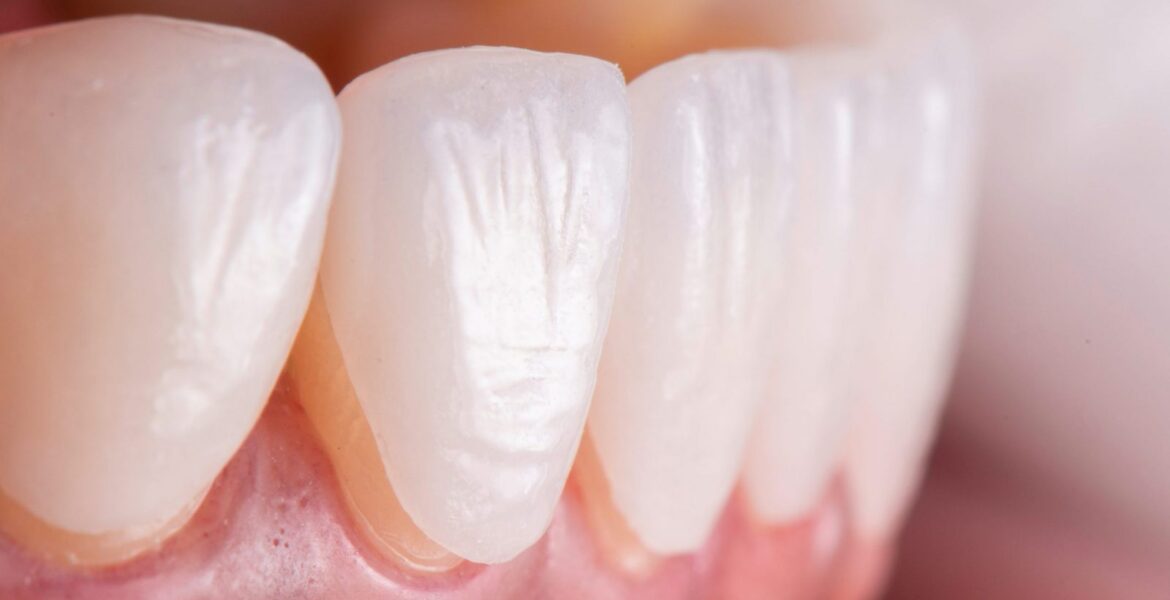 Veneers