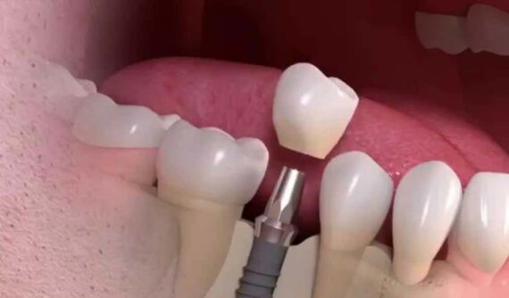 dental implant