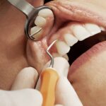 Dental implant procedure at Lagos clinic